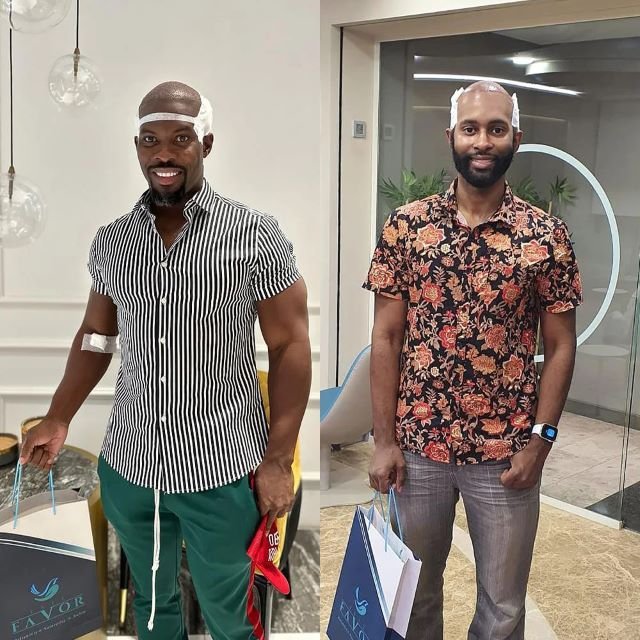 Afro hair transplant in Istanbul Este Favor