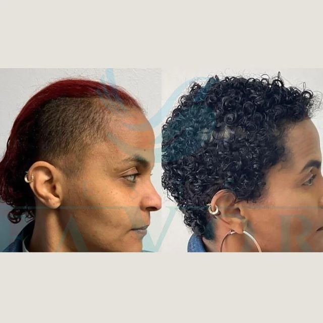 Afro hair transplant in Turkey