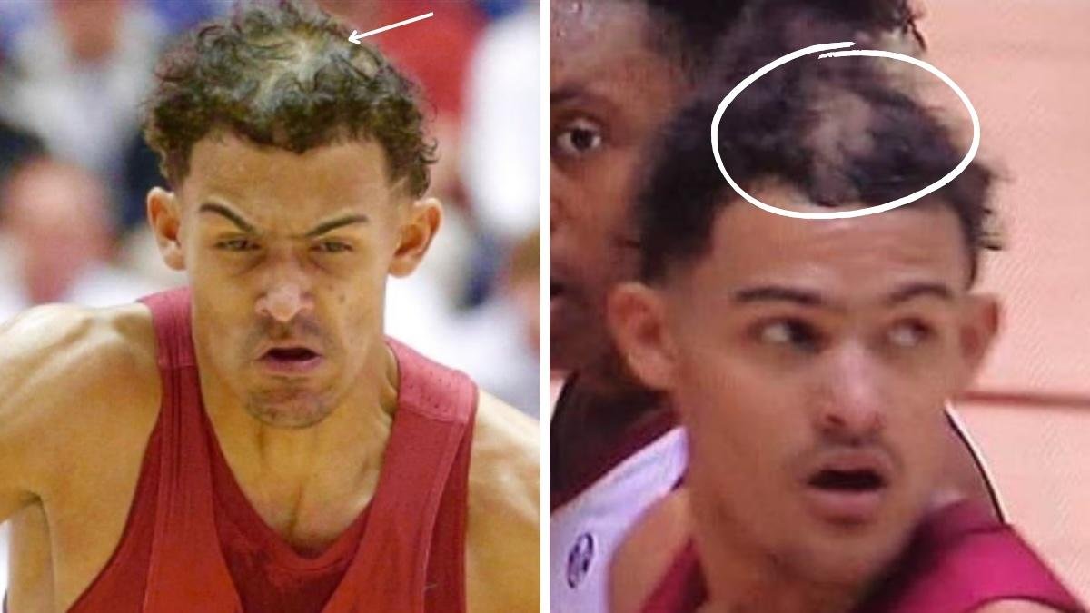 Trae Young hair transplant before and after photos