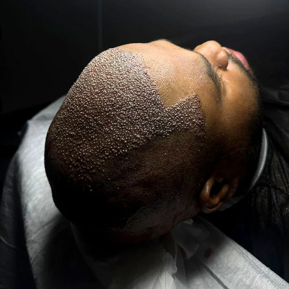 Afro hair transplant in Turkey