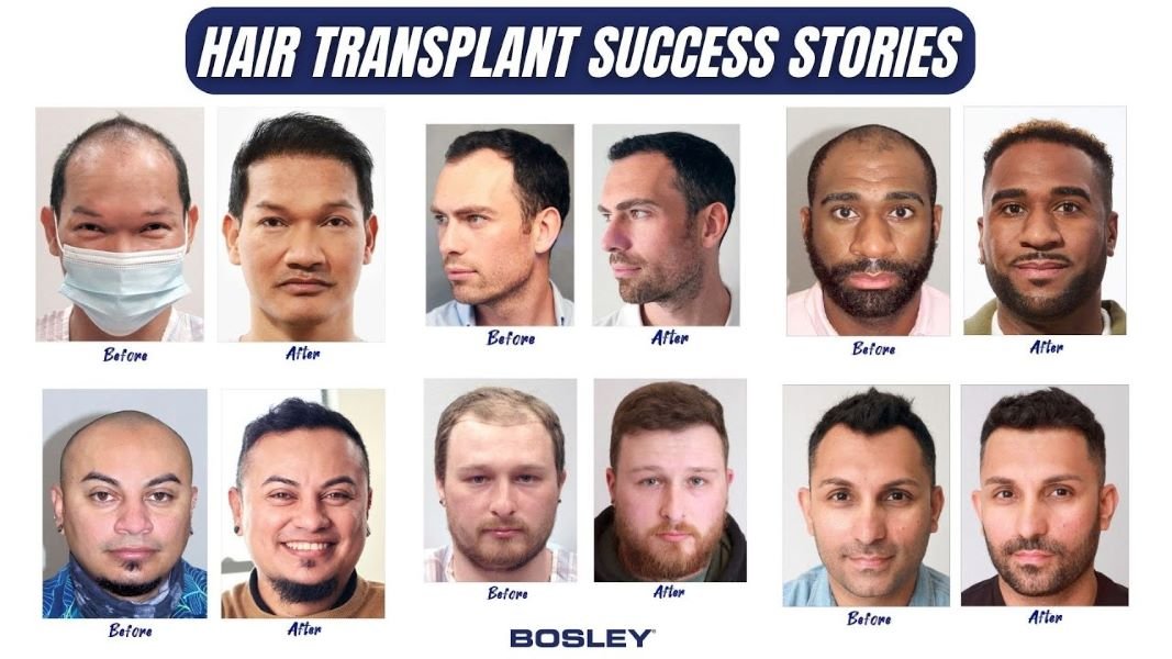 Bosley hair transplant success stories