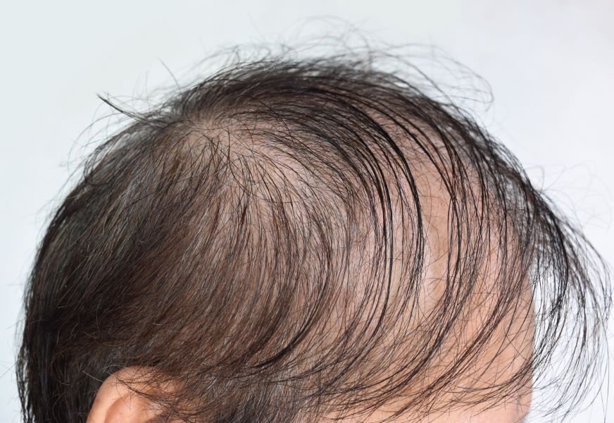 Diffuse Alopecia Treatment FUE vs FUT Hair Graft Costs