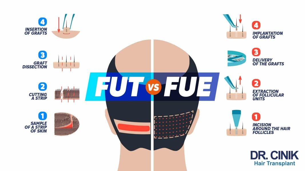 FUT vs. FUE hair transplant technique