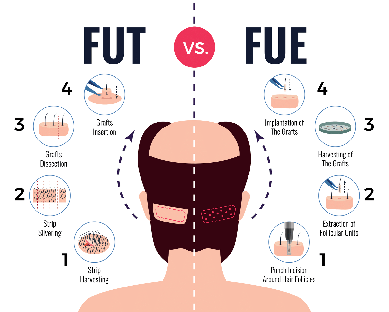 Type 1 hair transplant in Turkey FUT vs FUE