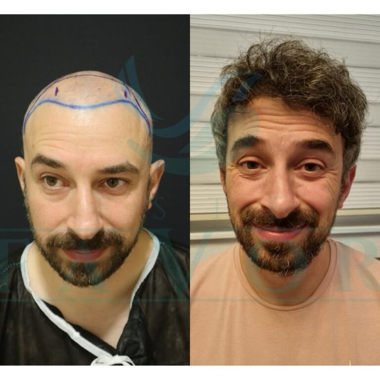 Type 3 Curly Hair Transplant