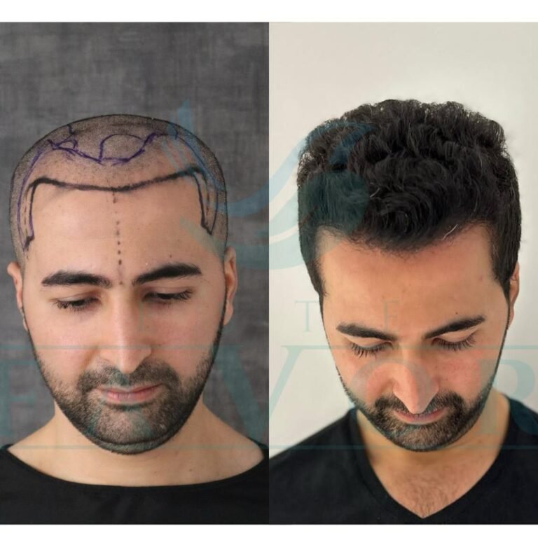 Type 3 Curly Hair Transplant in Turkey