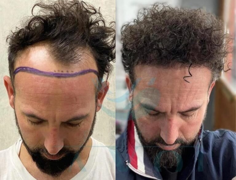 Type 3 Curly Hair Transplant in Istanbul