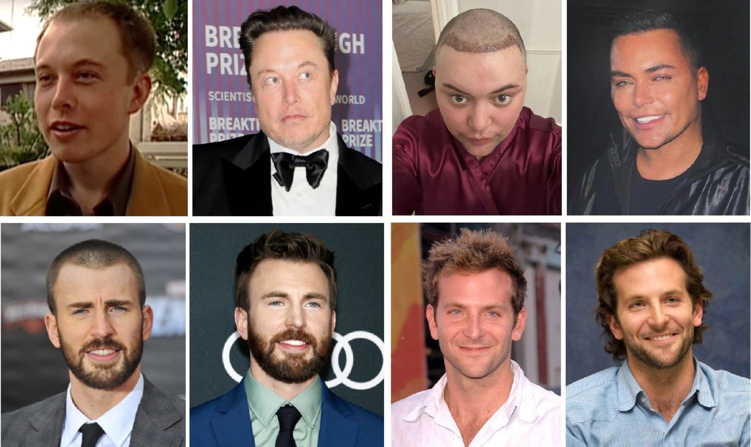 Celebrities who knows with hair transplant