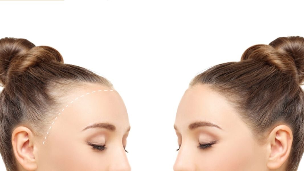 Hormonal Hair Loss Hair Graft Costs Comparison