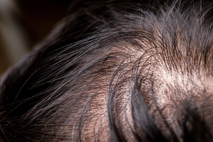 Thin Hair Loss Scalp Hair Graft Costs