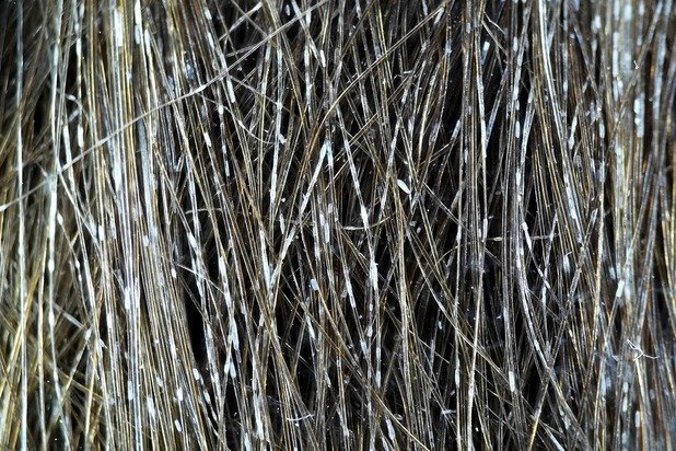 White piedra hair nodules